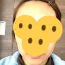 ボトックス（エラ・小顔） Wi Clinic（ウィ クリニック） 吉祥寺院 DAY 12 サムネイル用