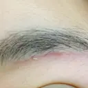 上まぶたの脂肪取り / 眉下切開 THE FIRST CLINIC 多摩センター院 DAY 37 サムネイル用