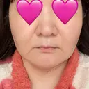 糸リフト / 脂肪吸引（顔） / メーラーファット除去 / ジョールファット除去 湘南美容クリニック 秋葉原院 DAY 101 サムネイル用