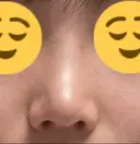 鼻尖形成（切開） / 軟骨移植 / 鼻修正 / 鼻柱下降・鼻唇角形成（猫手術） 東京シンデレラ美容外科 池袋院 DAY 66 サムネイル用