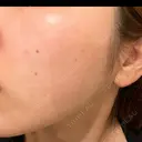 ピーリング（ハリ・ツヤ） 心斎橋KT美容クリニック AFTER サムネイル用