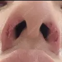 鼻孔縁挙上 大阪TAクリニック DAY 8 サムネイル用