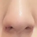 鼻孔縁挙上 大阪TAクリニック DAY 8 サムネイル用