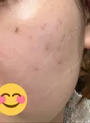 ほくろ・いぼ除去レーザー（肌） / シミ取りレーザー / ピコスポット 日比谷セントラルクリニック DAY 10 サムネイル用