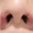 鼻孔縁挙上 大阪TAクリニック DAY 9 サムネイル用