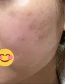 ほくろ・いぼ除去レーザー（肌） / シミ取りレーザー / ピコスポット 日比谷セントラルクリニック AFTER サムネイル用