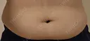 脂肪冷却（お腹） 美容皮膚科エルムクリニック 大阪院 DAY 125 サムネイル用