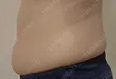 脂肪冷却（お腹） 美容皮膚科エルムクリニック 大阪院 DAY 139 サムネイル用