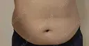 脂肪冷却（お腹） 美容皮膚科エルムクリニック 大阪院 AFTER サムネイル用
