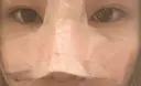 鼻尖形成（切開） / 軟骨移植 / 骨切幅寄せ 9BeautyClinic DAY 2 サムネイル用