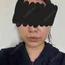 糸リフト / バッカルファット除去 / 脂肪吸引（顔） / メーラーファット除去 / 脂肪吸引注射（顔） SEA CLINIC（シークリニック） AFTER サムネイル用