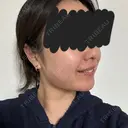糸リフト / バッカルファット除去 / 脂肪吸引（顔） / メーラーファット除去 / 脂肪吸引注射（顔） SEA CLINIC（シークリニック） DAY 75 サムネイル用