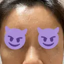 その他（目元） 聖心美容クリニック 六本木院 AFTER サムネイル用