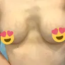 豊胸（シリコンバッグ） お茶の水美容形成クリニック DAY 169 サムネイル用