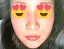 脂肪吸引（顔） SK新宿歌舞伎町美容外科・歯科 DAY 28 サムネイル用