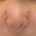 鼻尖形成（切開） / 軟骨移植 / 骨切幅寄せ 9BeautyClinic DAY 4 サムネイル用