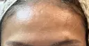 ボトックス（額） 東京形成美容外科 銀座院 DAY 10 サムネイル用