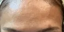 ボトックス（額） 東京形成美容外科 銀座院 DAY 9 サムネイル用