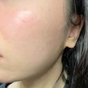 光治療（フォトフェイシャルなど） B-LINE CLINIC 池袋院 AFTER サムネイル用