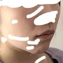 脂肪吸引（顔） / ジョールファット除去 / 脂肪注入（輪郭） WOM CLINIC GINZA （ワム クリニック ギンザ） DAY 170 サムネイル用