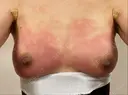 豊胸（脂肪注入） 湘南美容クリニック 渋谷院 DAY 2 サムネイル用