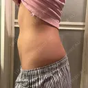 医療痩身（お腹） 湘南美容クリニック 博多院 AFTER サムネイル用