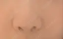鼻尖形成（切開） / 軟骨移植 / 骨切幅寄せ 9BeautyClinic DAY 6 サムネイル用