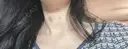 マイクロボトックス / ボトックス（眉間） / ボトックス（目尻） / ボトックス（額） DMTC美容皮膚科 大宮院 DAY 2 サムネイル用
