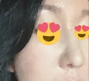 マイクロボトックス / ボトックス（眉間） / ボトックス（目尻） / ボトックス（額） DMTC美容皮膚科 大宮院 DAY 2 サムネイル用