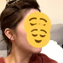糸リフト / 脂肪吸引注射（顔） 湘南美容クリニック 吉祥寺院 DAY 21 サムネイル用