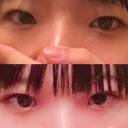 二重切開 / 上まぶたの脂肪取り 聖心美容クリニック 横浜院 DAY 20 サムネイル用