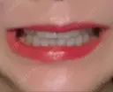 その他（審美歯科/矯正歯科） / 矯正（ワイヤー） / セラミック アニバーサリーデンタルギンザ DAY 1428 サムネイル用