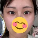 ボトックス（目尻） TCB東京中央美容外科 梅田茶屋町院 DAY 29 サムネイル用