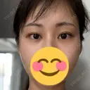 ボトックス（目尻） TCB東京中央美容外科 梅田茶屋町院 DAY 43 サムネイル用