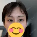 ボトックス（目尻） TCB東京中央美容外科 梅田茶屋町院 DAY 80 サムネイル用