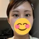 ボトックス（目尻） TCB東京中央美容外科 梅田茶屋町院 DAY 85 サムネイル用