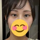 ボトックス（目尻） TCB東京中央美容外科 梅田茶屋町院 DAY 87 サムネイル用