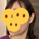 ボトックス（エラ・小顔） Wi Clinic（ウィ クリニック） 吉祥寺院 DAY 20 サムネイル用