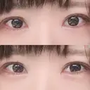 二重切開 / 目元修正 ルネッサンス美容外科医院 神戸院 DAY 82 サムネイル用