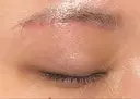 眼瞼下垂（切開） 水の森美容クリニック 福岡院 DAY 50 サムネイル用