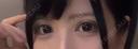 二重切開 / 目頭切開 / 眼瞼下垂（切開） / 上まぶたの脂肪取り エターナル美容クリニック DAY 79 サムネイル用