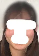 糸リフト / 脂肪吸引（顔） / ジョールファット除去 / ボトックス（エラ・小顔） ルラ美容クリニック 新宿院 DAY 161 サムネイル用