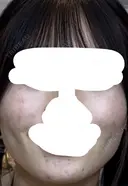 糸リフト / 脂肪吸引（顔） / ジョールファット除去 / ボトックス（エラ・小顔） ルラ美容クリニック 新宿院 DAY 163 サムネイル用