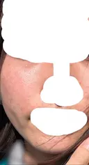 糸リフト / 脂肪吸引（顔） / ジョールファット除去 / ボトックス（エラ・小顔） ルラ美容クリニック 新宿院 DAY 166 サムネイル用