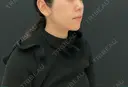 脂肪吸引（顔） / ジョールファット除去 湘南美容クリニック 秋葉原院 DAY 101 サムネイル用
