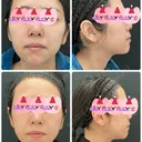 脂肪吸引（顔） / ジョールファット除去 湘南美容クリニック 秋葉原院 DAY 101 サムネイル用