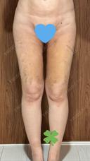 脂肪吸引（顔） / 脂肪吸引（脚） / 脂肪吸引（お尻） Mods Clinic（モッズクリニック） 福岡院 DAY 14 サムネイル用