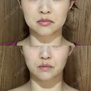 脂肪吸引（顔） / 脂肪吸引（脚） / 脂肪吸引（お尻） Mods Clinic（モッズクリニック） 福岡院 DAY 14 サムネイル用