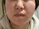 糸リフト / バッカルファット除去 / 脂肪吸引（顔） / 下まぶたたるみ取り / 脂肪注入（額） / メーラーファット除去 / ジョールファット除去 / 脂肪注入（目の下） / ボトックス（眉間） 湘南美容クリニック 秋葉原院 AFTER サムネイル用