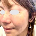 脂肪溶解注射（顔） / ヒアルロン酸注入（頬） / ボトックス（眉間） / ボトックス（目尻） / ハイフ（顔） TCB東京中央美容外科 立川院 DAY 2 サムネイル用